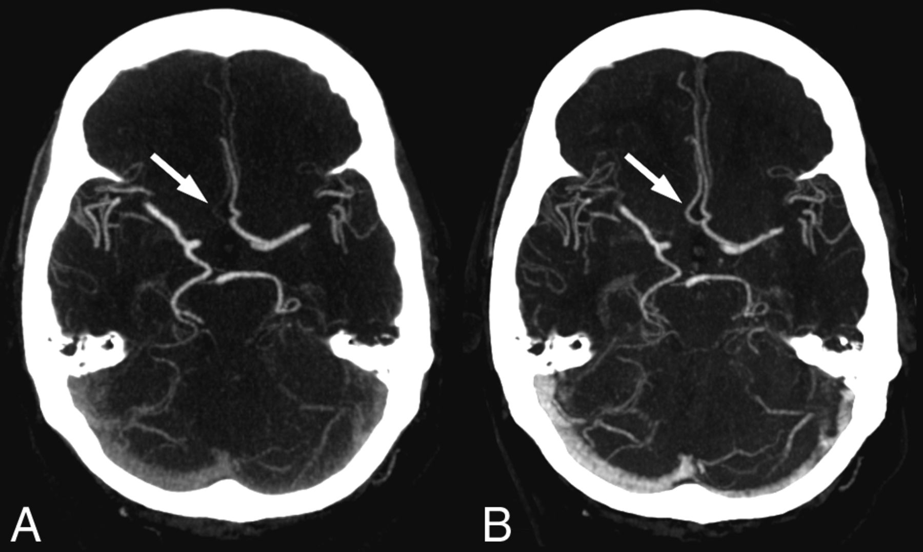 CT Angiogram of brain