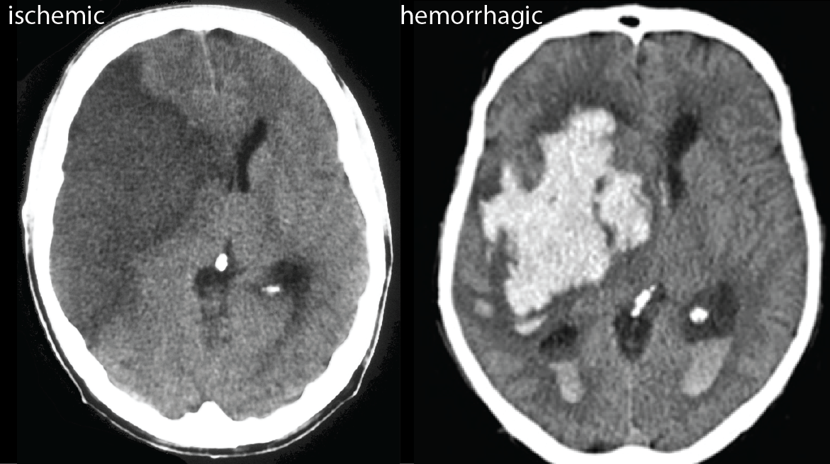 CT scan of brain