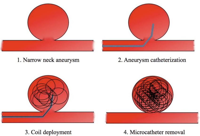 Embolization