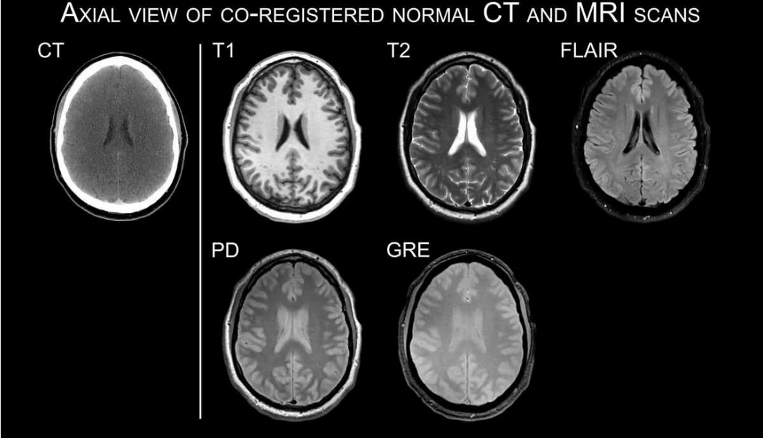 Difference between MRI and CT scans