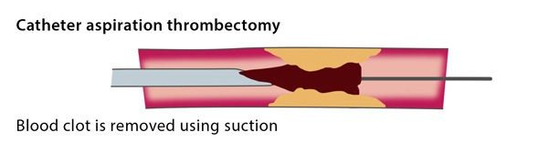 suction_image